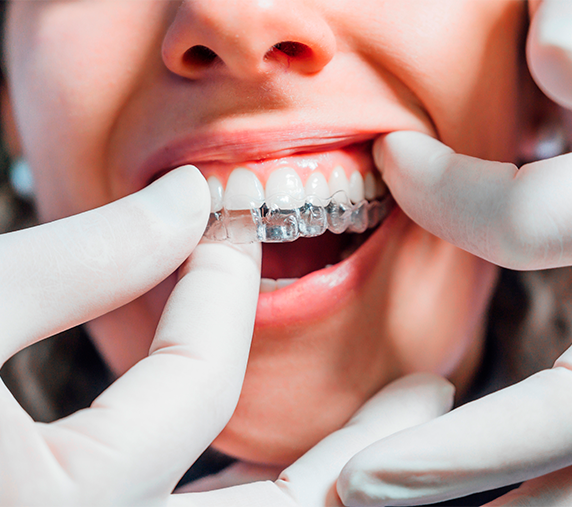 Alinhadores Invisalign — Clínica Eduardo Gama, São José dos Campos