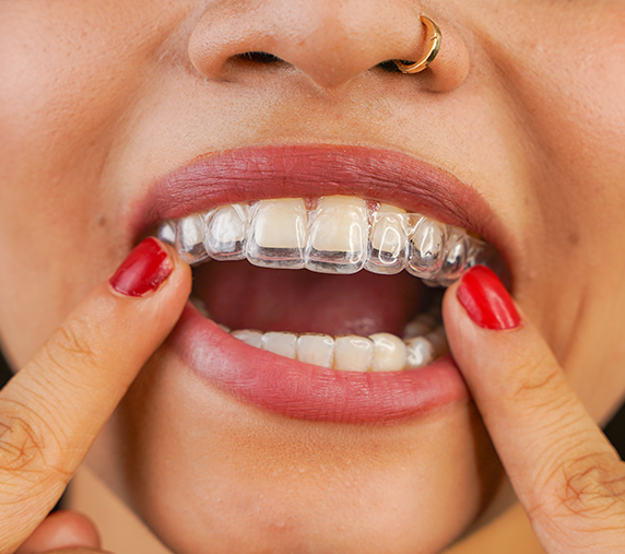 Alinhadores Invisalign — Clínica Eduardo Gama, São José dos Campos