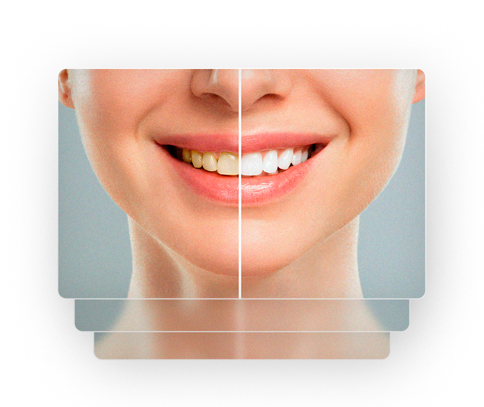 Clareamento dental na Clínica Eduardo Gama, São José dos Campos