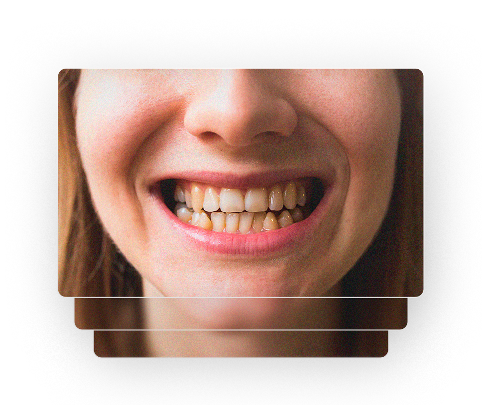 Envelhecimento precoce dos dentes — Clínica Eduardo Gama, São José dos Campos