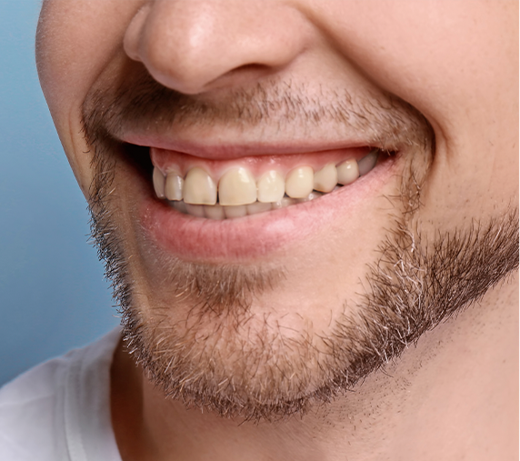 Envelhecimento precoce dos dentes — Clínica Eduardo Gama, São José dos Campos