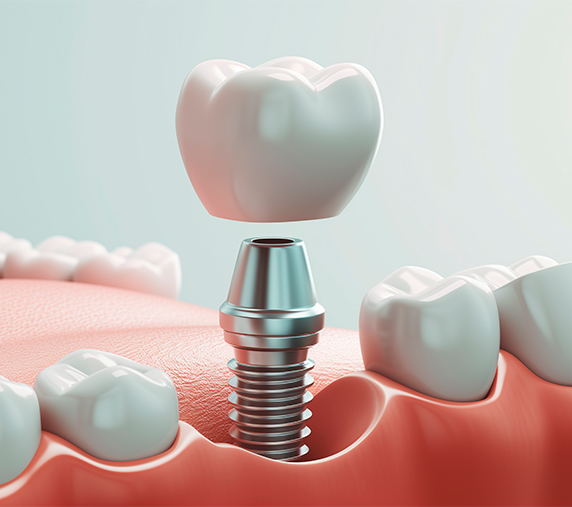 Implante dentário — Dr. Eduardo Gama, São José dos Campos