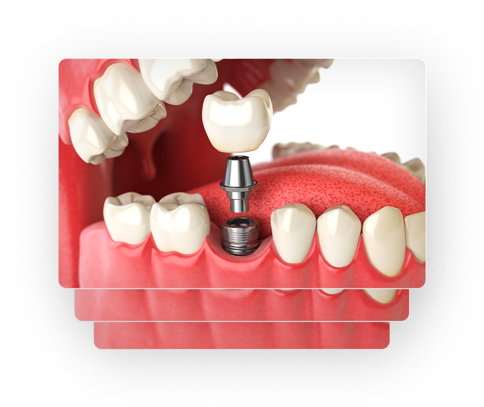 Implante dentário — Dr. Eduardo Gama, São José dos Campos