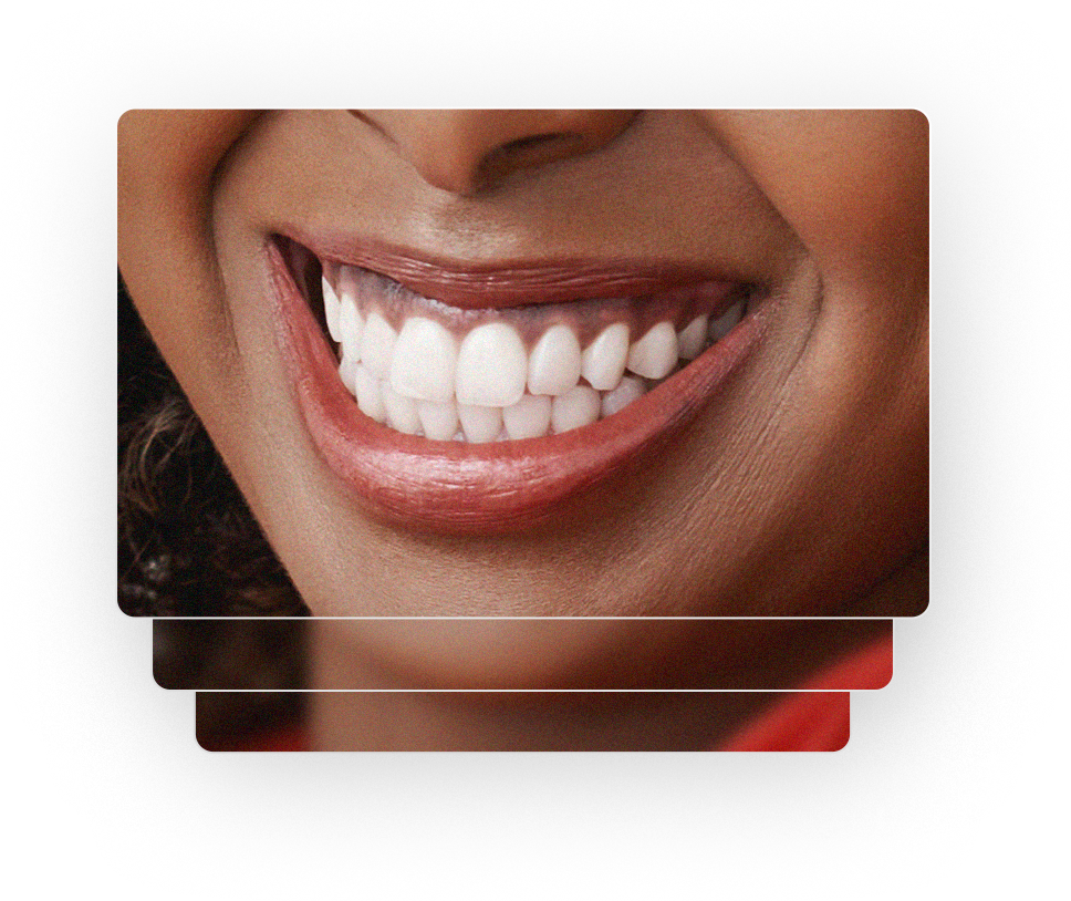 Lentes de contato dental de porcelana — Dr. Eduardo Gama, São José dos Campos