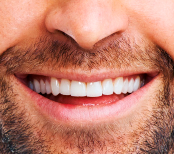 Lentes de contato dental de porcelana — Dr. Eduardo Gama, São José dos Campos