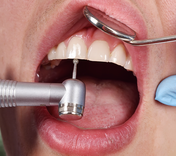 Restauração e correção dental — Clínica Eduardo Gama, São José dos Campos